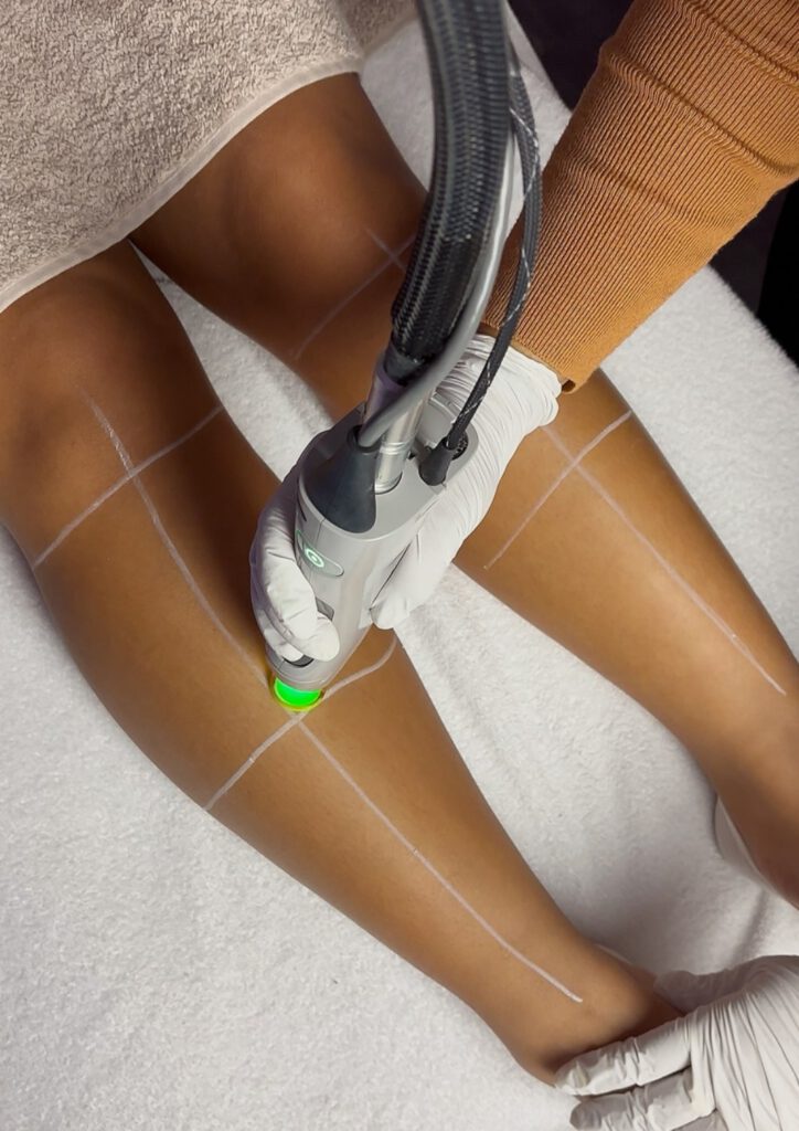 laserontharing benen